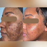 Jessner Home Chemical Peel