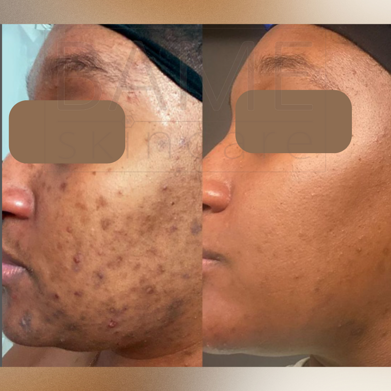 Salicylic Acid 30% Home Peel