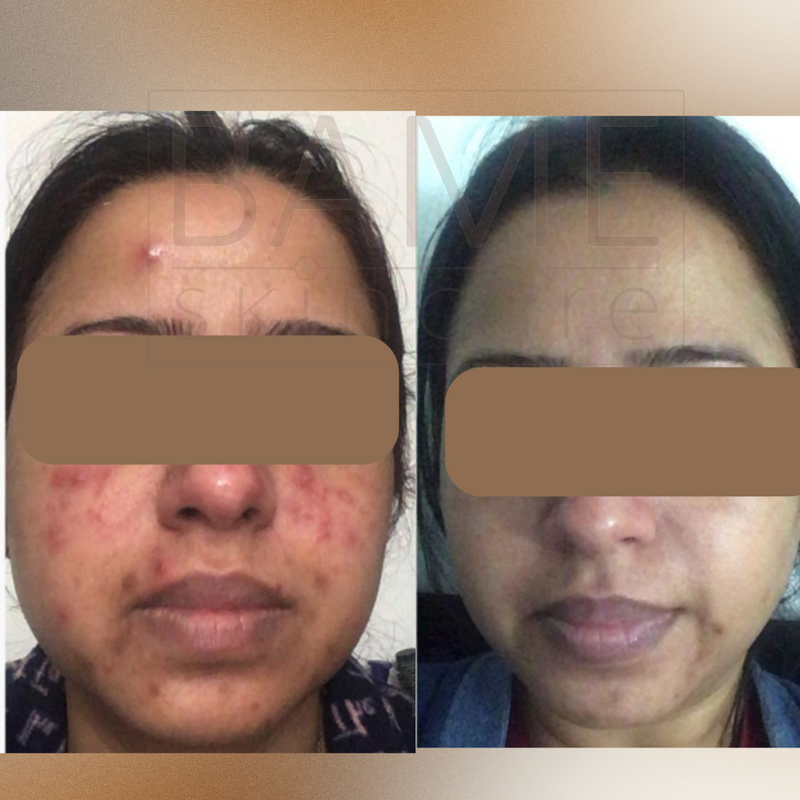 Salicylic Acid 30% Home Peel