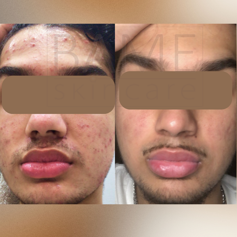 Salicylic Acid 30% Home Peel