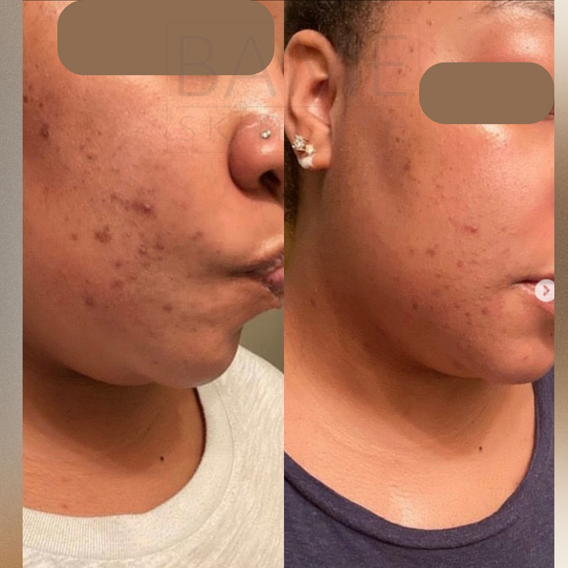 Salicylic Acid 30% Home Peel